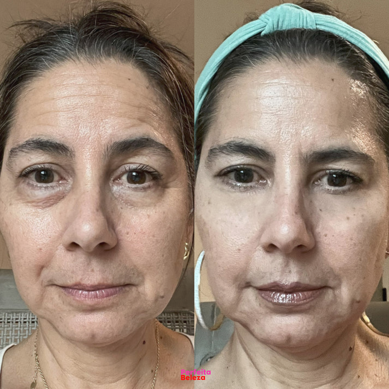 LumiEyes - A Tecnologia que Ilumina e rejuvenesce seu olhar